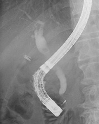 ERCP（内視鏡的逆行性胆管膵管造影）