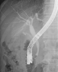 ERCP（内視鏡的逆行性胆管膵管造影）